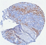 IHC staining of FFPE human tonsil tissue with Interferon regulatory factor 4 antibody (clone MUM1/8560R). HIER: boil tissue sections in pH 9 10mM Tris with 1mM EDTA for 20 min and allow to cool before testing.