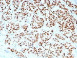 IHC staining of FFPE human breast carcinoma tissue with Estrogen Receptor alpha antibody (clone rESR1/8761). HIER: boil tissue sections in pH 9 10mM Tris with 1mM EDTA for 20 min and allow to cool before testing.