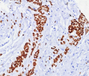 ER alpha Antibody Rabbit Monoclonal Breast Cancer IHC. Immunohistochemistry of ER alpha Antibody in human breast carcinoma. Formalin-fixed, paraffin-embedded human breast carcinoma tissue shows strong nuclear HRP-DAB brown staining in malignant epithelial cells, while adjacent stromal components are largely negative. Staining was performed using rabbit monoclonal clone ESR1/7444R following heat-induced epitope retrieval by boiling tissue sections in pH 9 10 mM Tris buffer with 1 mM EDTA for 20 min and cooling prior to antibody incubation. The nuclear staining pattern is consistent with expected Estrogen Receptor alpha / ESR1 expression in hormone receptor-positive breast carcinoma cells.