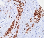 Formalin fixed paraffin embedded human breast carcinoma tissue with ER alpha antibody (clone ESR1/7444R). HIER: boil tissue sections in pH 9 10mM Tris with 1mM EDTA for 20 min and allow to cool before testing.