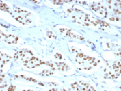 ER-A Antibody Recombinant Rabbit MAb Breast Cancer IHC. Immunohistochemistry of ER-A Antibody Recombinant Rabbit MAb in human breast carcinoma. Formalin-fixed, paraffin-embedded human breast carcinoma tissue shows strong nuclear HRP-DAB brown staining in tumor epithelial cells, while surrounding stromal elements are largely negative. Staining was performed using clone ESR1/8407R following heat-induced epitope retrieval by boiling tissue sections in pH 9 10 mM Tris buffer with 1 mM EDTA for 20 min and cooling prior to incubation. The nuclear staining pattern is consistent with expected Estrogen Receptor alpha / ESR1 expression in hormone receptor-positive breast carcinoma cells.