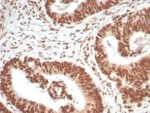 IHC staining of FFPE human colon carcinoma tissue with WT1-associated protein antibody (clone PCRP-WTAP-1A4). HIER: boil tissue sections in pH 9 10mM Tris with 1mM EDTA for 20 min and allow to cool before testing.