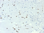 IHC staining of FFPE human chordoma tissue with Brachyury antibody (clone TBXT/7711R). HIER: boil tissue sections in pH 9 10mM Tris with 1mM EDTA for 20 min and allow to cool before testing.