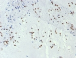 IHC staining of FFPE human chordoma tissue with TBXT antibody (clone TBXT/7853R). HIER: boil tissue sections in pH 9 10mM Tris with 1mM EDTA for 20 min and allow to cool before testing.