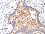 IHC staining of FFPE COVID positive human lung tissue with IL-6 antibody (clone IL6/4642) at 2ug/ml. HIER: boil tissue sections in pH 9 10mM Tris with 1mM EDTA for 20 min and allow to cool before testing.
