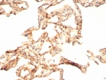 IHC staining of FFPE human COVID positive lung tissue with Interleukin 6antibody (clone IL6/4643) at 2ug/ml. HIER: boil tissue sections in pH 9 10mM Tris with 1mM EDTA for 20 min and allow to cool before testing.