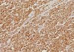 IHC staining of FFPE human colon carcinoma tissue with PMS2 antibody (clone PMS2/8374R). HIER: boil tissue sections in pH 9 10mM Tris with 1mM EDTA for 20 min and allow to cool before testing.