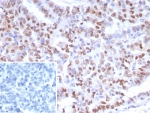IHC staining of FFPE human ovarian cancer tissue with PMS2 antibody (clone PMS2/8224R). Inset: PBS used in place of primary Ab (secondary Ab negative control). HIER: boil tissue sections in pH 9 10mM Tris with 1mM EDTA for 20 min and allow to cool before testing.