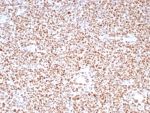 IHC staining of FFPE human colon carcinoma tissue with PMS2 antibody (clone PMS2/8224R). HIER: boil tissue sections in pH 9 10mM Tris with 1mM EDTA for 20 min and allow to cool before testing.