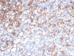 IHC staining of FFPE human renal cell carcinoma tissue with HSP27 antibody (clone rHSPB1/7298). HIER: boil tissue sections in pH 9 10mM Tris with 1mM EDTA for 20 min and allow to cool before testing.