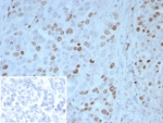 IHC staining of FFPE human ovarian carcinoma tissue with PAX4 antibody (clone PAX4/7598). Inset: PBS used in place of primary Ab (secondary Ab negative control). HIER: boil tissue sections in pH 9 10mM Tris with 1mM EDTA for 20 min and allow to cool before testing.