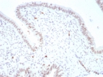 IHC staining of FFPE human ovarian carcinoma tissue with Paired box 4 antibody (clone PAX4/7599). HIER: boil tissue sections in pH 9 10mM Tris with 1mM EDTA for 20 min and allow to cool before testing.
