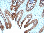IHC staining of FFPE human colon tissue with Cadherin 17 antibody (clone rCDH17/8512). HIER: boil tissue sections in pH 9 10mM Tris with 1mM EDTA for 20 min and allow to cool before testing.