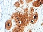 IHC staining of FFPE human breast carcinoma tissue with Prolactin-Induced Protein antibody (clone PIP/7477). HIER: boil tissue sections in pH 9 10mM Tris with 1mM EDTA for 20 min and allow to cool before testing.