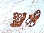 IHC staining of FFPE human breast carcinoma tissue with GCDFP-15 antibody (clone PIP/9076R). HIER: boil tissue sections in pH 9 10mM Tris with 1mM EDTA for 20 min and allow to cool before testing.