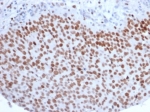 IHC staining of FFPE human bladder carcinoma with Enhancer of zeste homolog 2 antibody (clone EZH2/6988). HIER: boil tissue sections in pH 9 10mM Tris with 1mM EDTA for 20 min and allow to cool before testing.