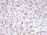 IHC staining of FFPE human renal cell carcinoma tissue with EZH2 antibody (clone EZH2/7507). HIER: boil tissue sections in pH 9 10mM Tris with 1mM EDTA for 20 min and allow to cool before testing.