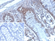 IHC staining of FFPE human colon carcinoma tissue with KMT6 antibody (clone EZH2/4194). Inset: PBS used in place of primary Ab (secondary Ab negative control). HIER: boil tissue sections in pH 9 10mM Tris with 1mM EDTA for 20 min and allow to cool before testing.