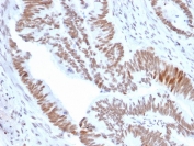 IHC staining of FFPE human colon tumor tissue with DBC1 antibody (clone PCRP-KIAA1967-1D10). HIER: boil tissue sections in pH 9 10mM Tris with 1mM EDTA for 20 min and allow to cool before testing.