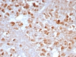 IHC staining of FFPE human pancreas tissue with Carboxypeptidase A1 antibody (clone CPA1/8163R). HIER: boil tissue sections in pH 9 10mM Tris with 1mM EDTA for 20 min and allow to cool before testing.