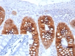 IHC staining of FFPE human colon tissue with Cadherin 17 antibody (clone CDH17/8513R). Inset: PBS used in place of primary Ab (secondary Ab negative control). HIER: boil tissue sections in pH 9 10mM Tris with 1mM EDTA for 20 min and allow to cool before testing.