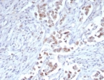 IHC staining of FFPE human breast carcinoma tissue with TRPS1 antibody (clone TRPS1/7912R). Strong nuclear staining using TRPS1/7912R mAb at 2ug/ml. HIER: boil tissue sections in pH 9 10mM Tris with 1mM EDTA for 20 min and allow to cool before testing.