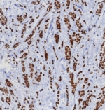 IHC staining of FFPE human mammary gland carcinoma tissue with TRPS1 antibody (clone TRPS1/8008R). HIER: boil tissue sections in pH 9 10mM Tris with 1mM EDTA for 20 min and allow to cool before testing.