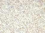 IHC staining of FFPE human lymphoma with c-Myc antibody (clone MYC/7854R). HIER: boil tissue sections in pH 9 10mM Tris with 1mM EDTA for 20 min and allow to cool before testing.