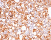 IHC staining of FFPE human parathyroid tissue with Carbonic Anhydrase IX antibody (clone CA9/4019). HIER: boil tissue sections in pH 9 10mM Tris with 1mM EDTA for 20 min and allow to cool before testing.