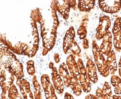 IHC staining of FFPE human kidney tissue with Carbonic Anhydrase IX antibody (clone CA9/4019). Inset: PBS used in place of primary Ab (secondary Ab negative control). HIER: boil tissue sections in pH 9 10mM Tris with 1mM EDTA for 20 min and allow to cool before testing.