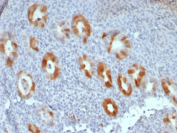 Cyclin-dependent kinase inhibitor 2A Antibody Cervical Carcinoma IHC. Immunohistochemistry of Cyclin-dependent kinase inhibitor 2A antibody in human cervical carcinoma tissue. The monoclonal clone rCDKN2A/8061 demonstrates strong nuclear and cytoplasmic HRP-DAB brown staining in malignant epithelial cell clusters, consistent with overexpression of p16INK4a in RB pathway dysregulation. Tumor glands and cohesive nests are clearly highlighted against surrounding stromal and inflammatory cells, which show minimal background staining. Heat-induced epitope retrieval was performed by boiling tissue sections in pH 9 10mM Tris with 1mM EDTA for 20 minutes followed by cooling prior to antibody incubation.