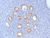 CDKN2A Antibody Human Cervix Tissue IHC. Immunohistochemistry of CDKN2A antibody in human cervix tissue. The recombinant mouse mAb clone rCDKN2A/8004 demonstrates nuclear and cytoplasmic HRP-DAB brown staining in epithelial cells, consistent with expression of p16INK4a in dysplastic or neoplastic cervical epithelium. Positive epithelial cell clusters are clearly distinguished from surrounding stromal and inflammatory cells, which show minimal background staining. Heat-induced epitope retrieval was performed by boiling tissue sections in pH 9 10mM Tris with 1mM EDTA for 20 minutes followed by cooling prior to antibody incubation.