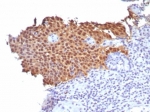 IHC staining of FFPE human cervical carcinoma tissue with P16INK4a antibody (clone CDKN2A/8223R). HIER: boil tissue sections in pH 9 10mM Tris with 1mM EDTA for 20 min and allow to cool before testing.