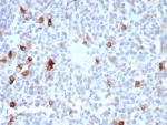 IHC staining of FFPE human melanoma tissue with Melan-A antibody (clone MLANA/8365R). HIER: boil tissue sections in pH 9 10mM Tris with 1mM EDTA for 20 min and allow to cool before testing.