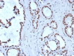 IHC staining of FFPE human prostate carcinoma tissue with Transducin-like enhancer protein 1 antibody (clone TLE1/8007R). HIER: boil tissue sections in pH 9 10mM Tris with 1mM EDTA for 20 min and allow to cool before testing.