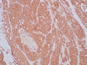 IHC staining of FFPE human lung carcinoma tissue with TrkB antibody (clone NTRK2/4673). HIER: boil tissue sections in pH 9 10mM Tris with 1mM EDTA for 20 min and allow to cool before testing.