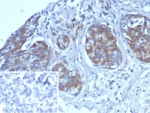 IHC staining of FFPE human ovarian cancer tissue with AMBP antibody (clone AMBP/4533). Inset: PBS used in place of primary Ab (secondary Ab negative control). HIER: boil tissue sections in pH 9 10mM Tris with 1mM EDTA for 20 min and allow to cool before testing.