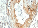 IHC staining of FFPE human lung tissue with Tenascin C antibody (clone TNC/4805). HIER: boil tissue sections in pH 9 10mM Tris with 1mM EDTA for 20 min and allow to cool before testing.