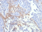 IHC staining of FFPE human lung tissue with TNC antibody (clone TNC/4806). HIER: boil tissue sections in pH 9 10mM Tris with 1mM EDTA for 20 min and allow to cool before testing.