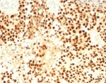 IHC staining of FFPE human adrenal cortex with Steroidogenic Factor 1 antibody (clone SF1/8000R). HIER: boil tissue sections in pH 9 10mM Tris with 1mM EDTA for 20 min and allow to cool before testing.