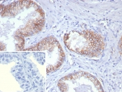 IHC staining of FFPE human prostate carcinoma tissue with Pan-Cadherin antibody (clone Pan-CAD/8020). Inset: PBS used in place of primary Ab (secondary Ab negative control). HIER: boil tissue sections in pH 9 10mM Tris with 1mM EDTA for 20 min and allow to cool before testing.
