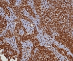 IHC staining of FFPE human ovarian cancer (serous) tissue with dsDNA antibody (clone DSD/8204R). HIER: boil tissue sections in pH 9 10mM Tris with 1mM EDTA for 20 min and allow to cool before testing.