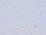 IHC staining of FFPE human HSV-infected tissue with Herpes Simplex Virus Type I antibody (clone HSVI/8375R). HIER: boil tissue sections in pH 9 10mM Tris with 1mM EDTA for 20 min and allow to cool before testing.