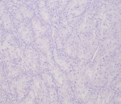 Negative control: IHC testing of FFPE human clear cell RCC tissue with TFE3 antibody (clone TFE3/6849R) at 2ug/ml. HIER: boil tissue sections in pH 9 10mM Tris with 1mM EDTA for 20 min and allow to cool before testing.