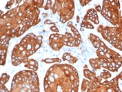 IHC staining of FFPE human esophageal cancer tissue with Tissue Inhibitor of Metalloproteinase 1 antibody (clone TIMP1/4358). HIER: boil tissue sections in pH 9 10mM Tris with 1mM EDTA for 20 min and allow to cool before testing.