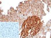 IHC staining of FFPE human pancreas tissue with CD99 antibody (clone MIC2/7866). Inset: PBS used in place of primary Ab (secondary Ab negative control). HIER: boil tissue sections in pH 9 10mM Tris with 1mM EDTA for 20 min and allow to cool before testing.