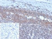 IHC staining of FFPE human tonsil tissue with BCOR antibody (clone BCOR/1311). Inset: PBS used in place of primary Ab (secondary Ab negative control). HIER: boil tissue sections in pH 9 10mM Tris with 1mM EDTA for 20 min and allow to cool before testing.