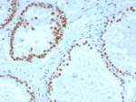 IHC staining of FFPE human prostate carcinoma tissue with Androgen Receptor antibody (clone DHTR/4929R). HIER: boil tissue sections in pH 9 10mM Tris with 1mM EDTA for 20 min and allow to cool before testing.