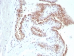 IHC staining of FFPE human prostate carcinoma tissue with Androgen Receptor antibody (clone rDHTR/8818). HIER: boil tissue sections in pH 9 10mM Tris with 1mM EDTA for 20 min and allow to cool before testing.