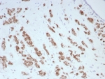 IHC staining of FFPE human breast carinoma tissue with Androgen Receptor antibody (clone DHTR/8698R). HIER: boil tissue sections in pH 9 10mM Tris with 1mM EDTA for 20 min and allow to cool before testing.